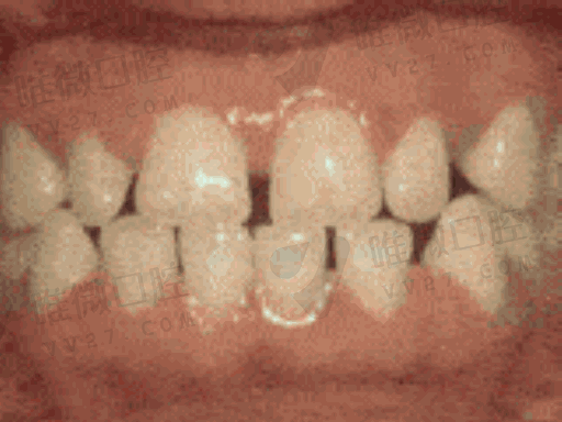 300和500假牙区别,200一颗的假牙对身体有害吗(图1)